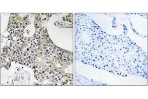 Immunohistochemistry analysis of paraffin-embedded human breast carcinoma tissue, using GPSN2 Antibody. (TECR anticorps  (AA 259-308))