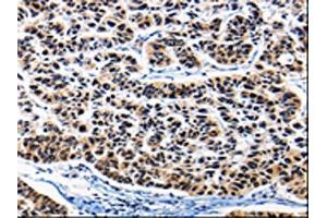 The image on the left is immunohistochemistry of paraffin-embedded Human lung cancer tissue using ABIN7189819(AP1B1 Antibody) at dilution 1/25, on the right is treated with synthetic peptide. (AP1B1 anticorps)