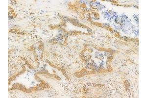 ABIN6262407 and ABIN6276441 at 1/100 staining human pancreatic carcinoma by IHC-P. (GRP94 anticorps  (C-Term))