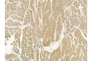 ABIN6264429 and ABIN6277277 at 1/100 staining human tongue carcinoma by IHC-P.