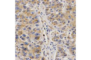 Immunohistochemistry of paraffin-embedded human liver cancer using VAPB Antibody. (VAPB anticorps)