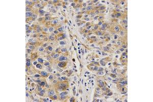 Immunohistochemistry of paraffin-embedded human liver cancer using VAPB Antibody. (VAPB anticorps)