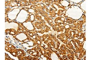 The image on the left is immunohistochemistry of paraffin-embedded Human thyroid cancer tissue using ABIN7190727(FZD6 Antibody) at dilution 1/60, on the right is treated with synthetic peptide. (FZD6 anticorps)