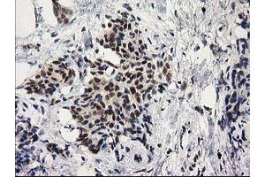 Immunohistochemical staining of paraffin-embedded Adenocarcinoma of Human breast tissue using anti-PRKCE mouse monoclonal antibody. (PKC epsilon anticorps)