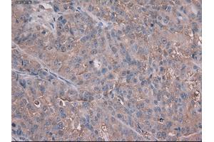 Immunohistochemical staining of paraffin-embedded Adenocarcinoma of colon using anti-Trim33 (ABIN2452534) mouse monoclonal antibody. (TRIM33 anticorps  (AA 887-1046))