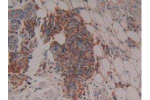 Detection of CYP27B1 in Human Skin Cancer Tissue using Polyclonal Antibody to Cytochrome P450 27B1 (CYP27B1)