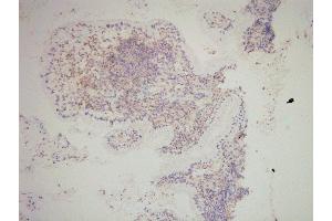 SNAI2 Antibody(ABIN6276471) staining human cervical carcinoma tissue sections by IHC-f at 1:200. (SLUG anticorps  (Internal Region))