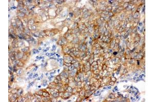 Anti- Bag3 Picoband antibody, IHC(P) IHC(P): Human Lung Cancer Tissue (BAG3 anticorps  (AA 100-561))