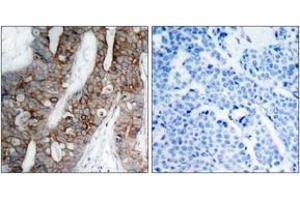 Immunohistochemistry analysis of paraffin-embedded human breast carcinoma tissue, using Integrin beta3 (Ab-773) Antibody.