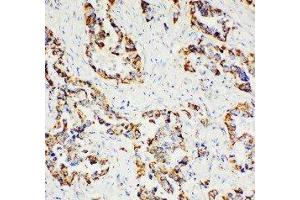 Anti-Paxillin antibody, IHC(P) IHC(P): Human Lung Cancer Tissue