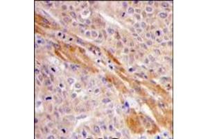 Formalin-fixed and paraffin-embedded human hepatocarcinoma tissue reacted with PGK1 Antibody (Center), which was peroxidase-conjugated to the secondary antibody, followed by DAB staining. (PGK1 anticorps  (Middle Region))