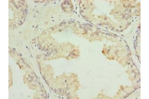 Immunohistochemistry of paraffin-embedded human prostate cancer using ABIN7164481 at dilution of 1:100 (GPR21 anticorps  (AA 305-349))