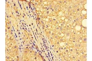 Immunohistochemistry of paraffin-embedded human liver cancer using ABIN7161893 at dilution of 1:100 (NR1D1 anticorps  (AA 246-558))