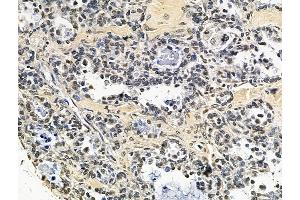 ABIN7096693 and ABIN7100758 at 1/100 staining human ovarian cancer by IHC-P. (IKZF5 anticorps)