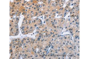 Immunohistochemistry of Human liver cancer using ATXN1 Polyclonal Antibody at dilution of 1:40 (Ataxin 1 anticorps)