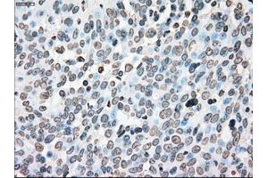 Immunohistochemical staining of paraffin-embedded Adenocarcinoma of colon tissue using anti-PLK1mouse monoclonal antibody. (PLK1 anticorps)