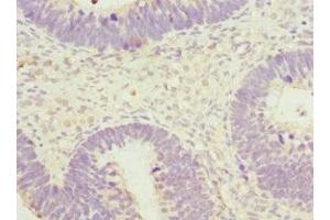 Immunohistochemistry of paraffin-embedded human ovarian cancer using ABIN7170599 at dilution of 1:100 (Spindlin 1 anticorps  (AA 1-262))