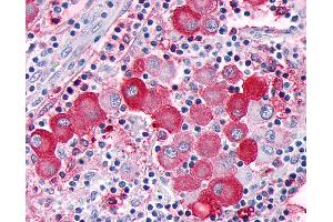 Anti-GPR63 antibody IHC of human Skin, Melanoma.