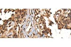 Immunohistochemistry of paraffin-embedded Human ovarian cancer tissue using CAMKK1 Polyclonal Antibody at dilution of 1:35(x200) (CAMKK1 anticorps)
