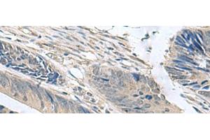 Immunohistochemistry of paraffin-embedded Human colorectal cancer tissue using NPHP1 Polyclonal Antibody at dilution of 1:60(x200)