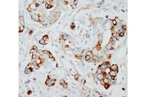Anti-SKP2 antibody, IHC(P) IHC(P): Human Mammary Cancer Tissue