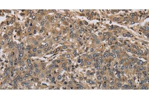 Immunohistochemistry of paraffin-embedded Human liver cancer using KCNA7 Polyclonal Antibody at dilution of 1:40