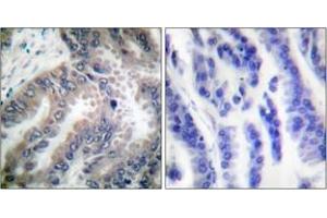 Immunohistochemistry analysis of paraffin-embedded human lung carcinoma tissue, using Caspase 8 (Ab-347) Antibody. (Caspase 8 anticorps  (AA 313-362))