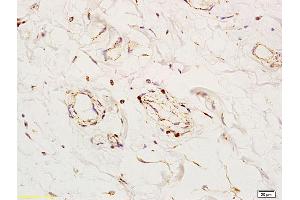 Formalin-fixed and paraffin embedded human colon tissue labeled with Anti-Angiomotin Polyclonal Antibody, Unconjugated (ABIN754873) at 1:200 followed by conjugation to the secondary antibody and DAB staining (Angiomotin anticorps  (AA 545-620))