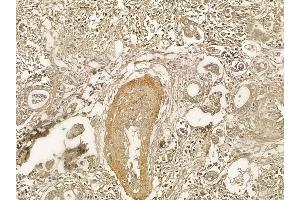 Vinculin Mouse Monoclonal Antibody at 1/100 staining human pancreatic cancer and adjacent non-tumor tissue by IHC-P.
