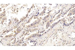 Detection of ACO1 in Human Lung cancer Tissue using Polyclonal Antibody to Aconitase 1 (ACO1) (Aconitase 1 anticorps  (AA 26-243))