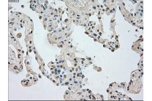 Immunohistochemical staining of paraffin-embedded Adenocarcinoma of breast tissue using anti-NTRK3 mouse monoclonal antibody. (NTRK3 anticorps)