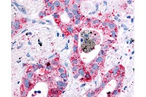 Anti-EGFR antibody IHC of human Lung, Non-Small Cell Carcinoma. (EGFR anticorps)