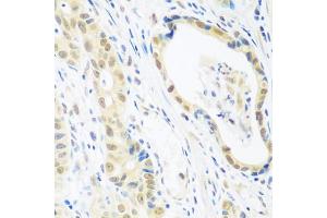 Immunohistochemistry of paraffin-embedded human stomach cancer using POLR2E antibody (ABIN5970880) at dilution of 1/100 (40x lens). (POLR2E anticorps)