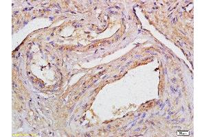 Formalin-fixed and paraffin embedded human cervical carcinoma labeled with Anti-CCDC90A Polyclonal Antibody, Unconjugated  at 1:200 followed by conjugation to the secondary antibody (CCDC90A anticorps  (AA 261-359))