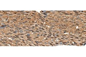 Immunohistochemistry of paraffin-embedded Human esophagus cancer tissue using CALML5 Polyclonal Antibody at dilution of 1:70(x200)