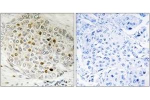 Immunohistochemistry analysis of paraffin-embedded human breast carcinoma tissue, using HDAC5 (Ab-498) Antibody. (HDAC5 anticorps  (AA 464-513))