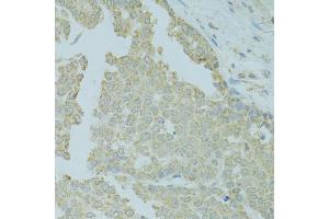 Immunohistochemistry of paraffin-embedded human colon carcinoma using MTFP1 antibody (ABIN5975088) at dilution of 1/100 (40x lens). (Mtfp1 anticorps)
