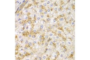 Immunohistochemistry of paraffin-embedded human liver cancer using ACTN1 antibody at dilution of 1:100 (400x lens).