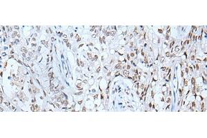Immunohistochemistry of paraffin-embedded Human lung cancer tissue using BRD3 Polyclonal Antibody at dilution of 1:60(x200) (BRD3 anticorps)