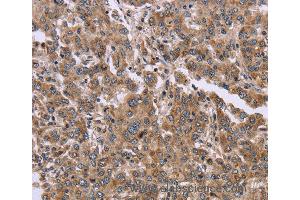 Immunohistochemistry of Human colon cancer using FAM3B Polyclonal Antibody at dilution of 1:30 (FAM3B anticorps)