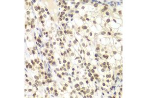Immunohistochemistry of paraffin-embedded human kidney cancer using UHRF2 antibody (ABIN6133264, ABIN6149911, ABIN6149913 and ABIN6217665) at dilution of 1:200 (40x lens).