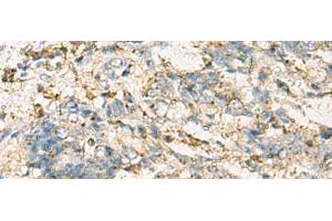 Immunohistochemistry of paraffin-embedded Human cervical cancer tissue using VTA1 Polyclonal Antibody at dilution of 1:60(x200) (VTA1 anticorps)