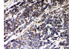 Anti- Peroxiredoxin 5 Picoband antibody, IHC(P) IHC(P): Human Lung Cancer Tissue (Peroxiredoxin 5 anticorps  (AA 66-198))