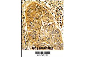 Formalin-fixed and paraffin-embedded human lung carcinoma with CALD1 Antibody , which was peroxidase-conjugated to the secondary antibody, followed by DAB staining. (Caldesmon anticorps  (AA 428-457))