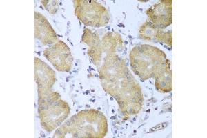 Immunohistochemistry of paraffin-embedded human gastric cancer using IGF2BP3 antibody.