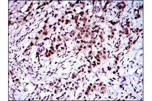 Immunohistochemical analysis of paraffin-embedded cervical cancer tissues using CFLAR mouse mAb with DAB staining.