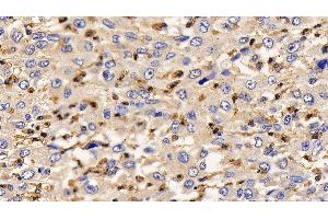Detection of IL13Ra2 in Human Liver cancer Tissue using Polyclonal Antibody to Interleukin 13 Receptor Alpha 2 (IL13Ra2) (IL13RA2 anticorps  (AA 238-334))