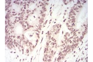 Immunohistochemical analysis of paraffin-embedded rectum cancer tissues using TERT mouse mAb with DAB staining.