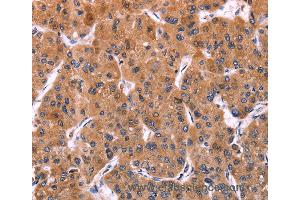 Immunohistochemistry of Human liver cancer using ERP29 Polyclonal Antibody at dilution of 1:40 (ERP29 anticorps)