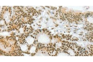 Immunohistochemistry of paraffin-embedded Human colon cancer using ANGPT4 Polyclonal Antibody at dilution of 1:70 (Angiopoietin 4 anticorps)